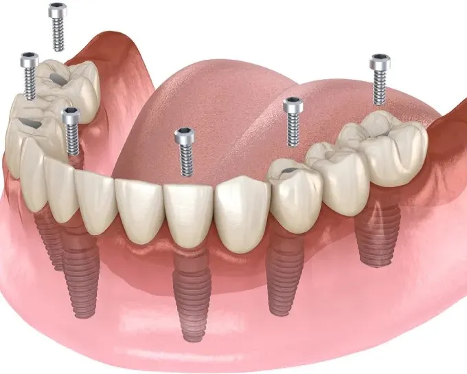 All Teeth Implant Treatment