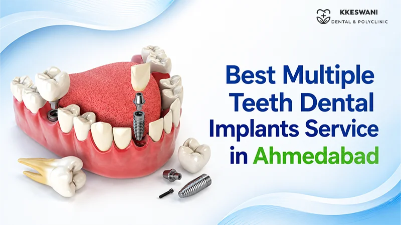 Best Multiple Teeth Dental Implants Service in Ahmedabad