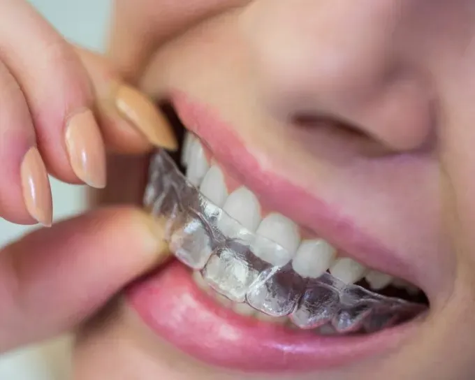 Crooked Teeth Treatment