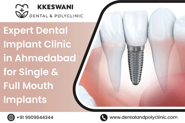 Expert Dental Implant Clinic in Ahmedabad for Single & Full Mouth Impl