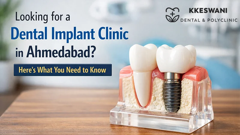 Looking for a Dental Implant Clinic in Ahmedabad? Here’s What You Need