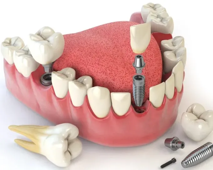 Multiple Teeth Implant Treatment