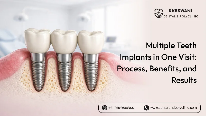 Multiple Teeth Implants in One Visit: Process, Benefits, and Results