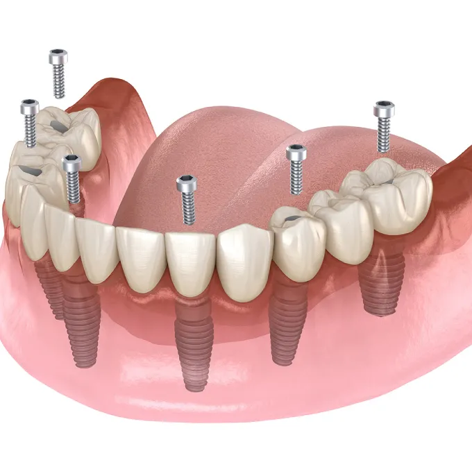 All Teeth Implants Tteatment
