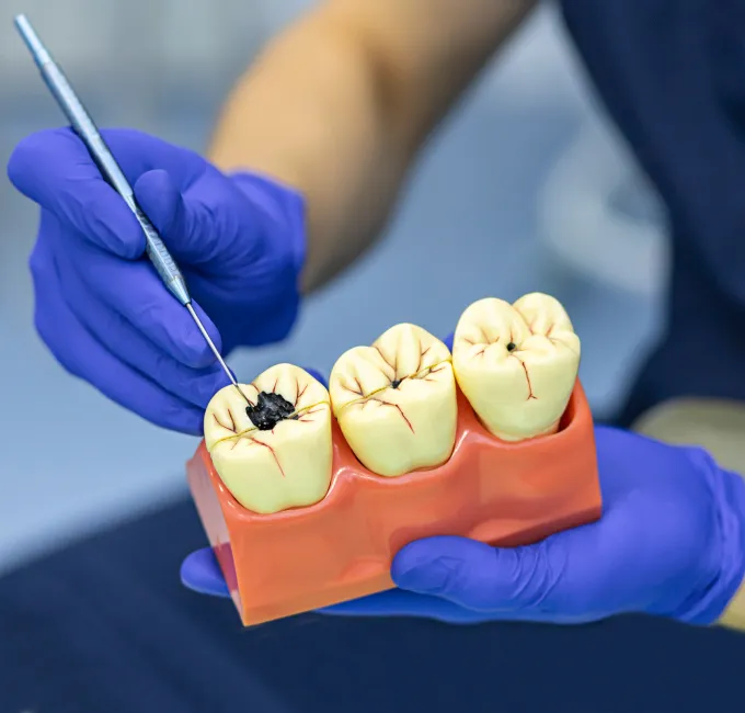 Tooth Extractions Treatmenet