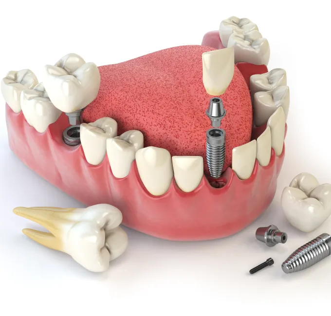Best Polyclinic for Multiple Teeth Implant