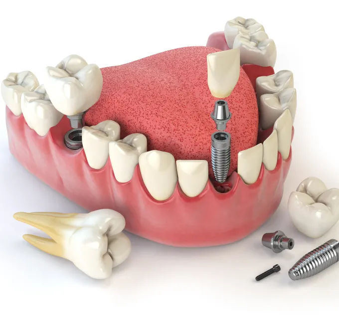 Multiple Teeth Implant Treatment