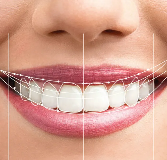 Smile Makeover Treatment in Ahmedabad