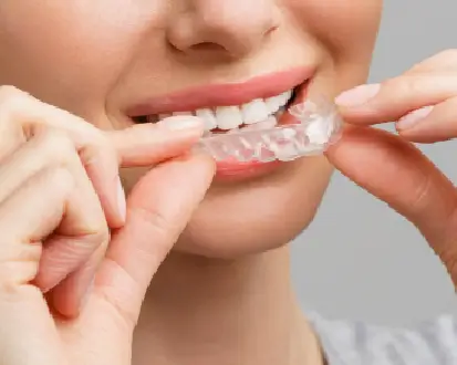 Clear Aligners