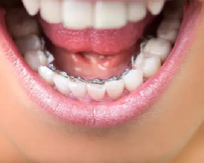 Lingual Braces