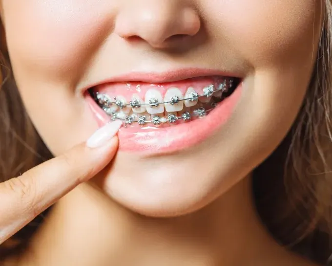 Dental Teeth Braces Treatment in Jodhpur