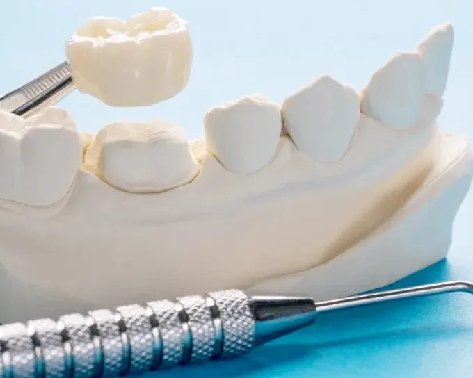 Crown & Bridge Treatment in Ahmedabad