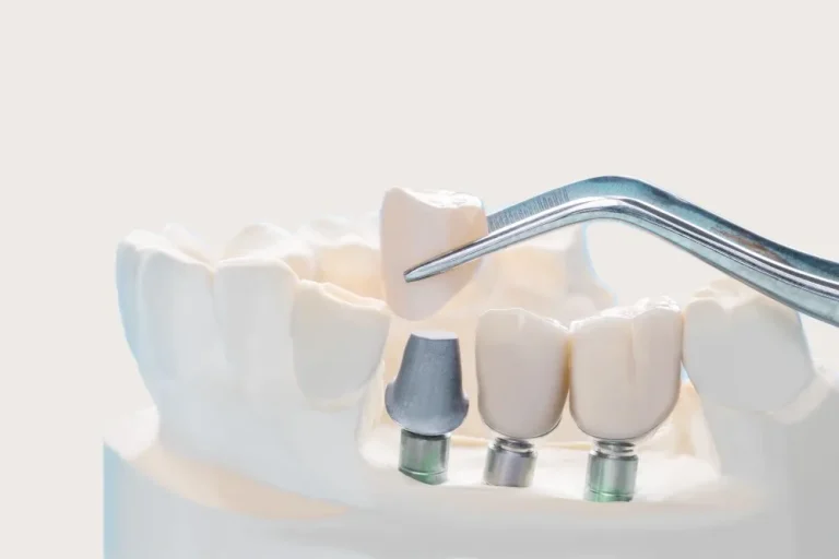 Dental Crown and Bridge in Ahmedabad – Complete Guide