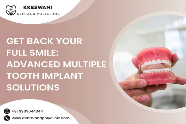 Get Back Your Full Smile: Advanced Multiple Tooth Implant Solutions