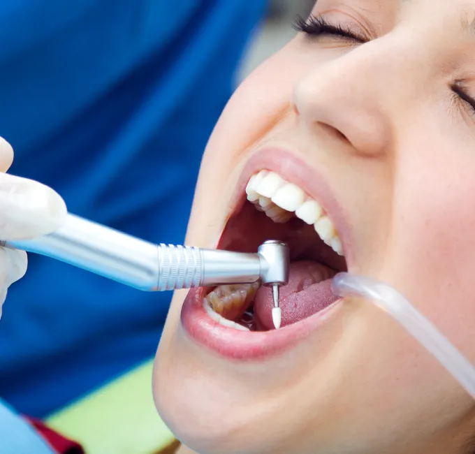Painless Root Canal Treatment in Ahmedabad