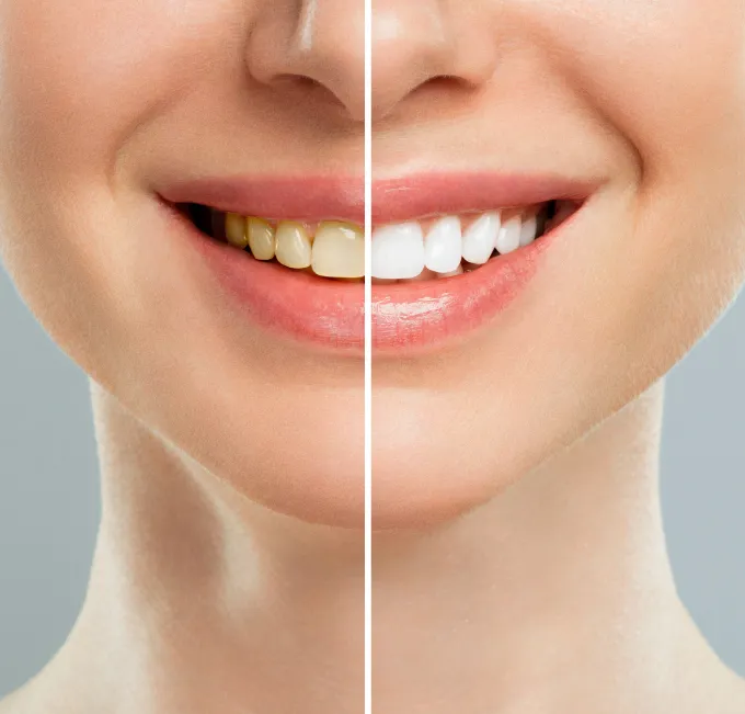 Teeth Cleaning & Polishing Services in Ahmedabad