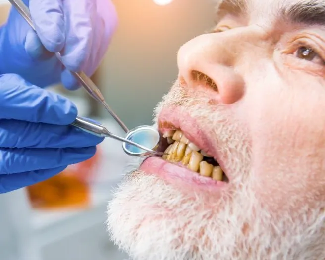 Tobacco and nicotine damaged teeth Treatment