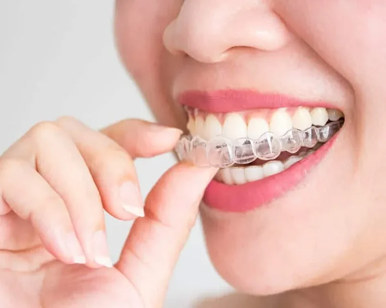 Transform Your Smile with Clear Aligners at Kkeswani Dental & Polyclinic