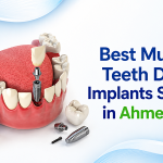 Best Multiple Teeth Dental Implants Service in Ahmedabad
